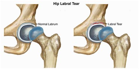 Hip Labral Tears — Pro Dynamic Physical Therapy Inc.