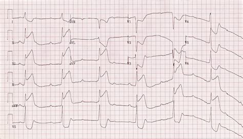 Inferior STEMI • LITFL • ECG Library Diagnosis