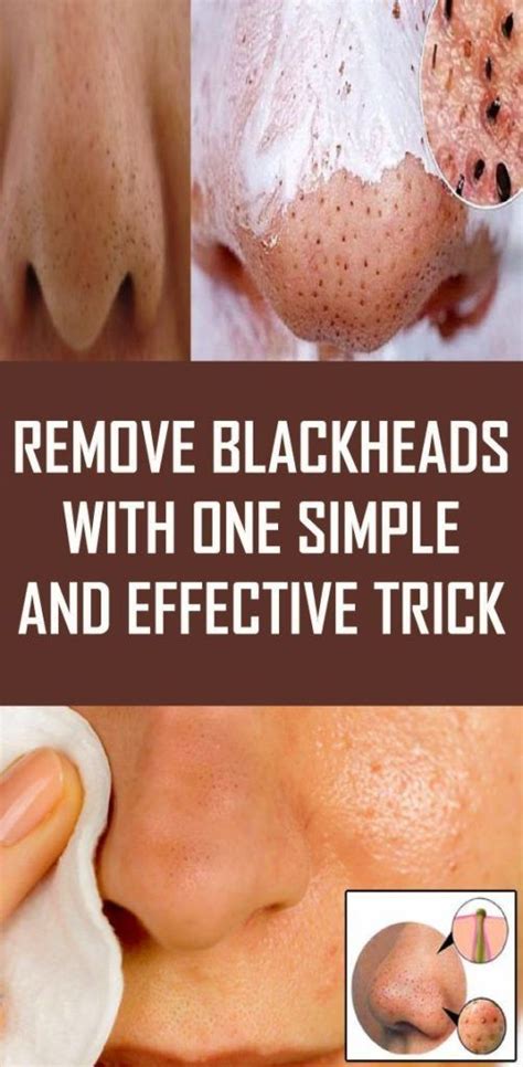 Sensitive Skin and How to Treat Blackheads - Rijal's Blog