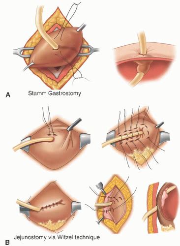 Placement of Feeding Tubes | Anesthesia Key