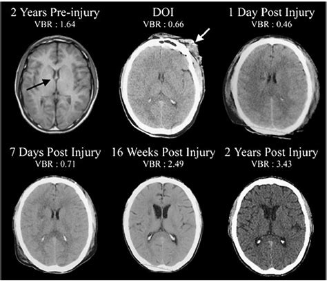 Brain Sciences | Free Full-Text | Damage to Myelin and Oligodendrocytes ...