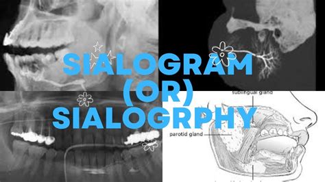 ☢️SIALOGRAM(OR) SIALOGRPHY/RADIOLOGICAL PROCEDURE/PAROTID GLANDS.☢️# ...