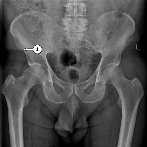 [DIAGRAM] X Ray Pelvis Diagram - MYDIAGRAM.ONLINE