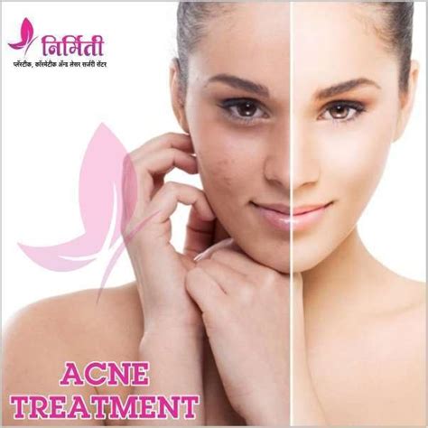 Effective Acne & Pimple Treatment in Kolhapur & Sangli