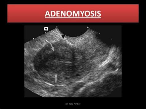 MEDICAL ULTRASOUND/ADENOMYOSIS