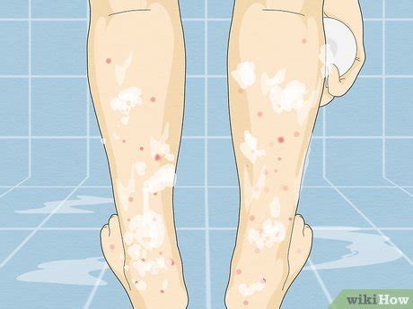 How to Treat No-See-Um Bites: Home Treatment for Quick Relief