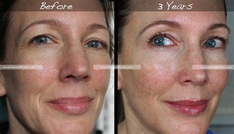 Retin-A for Wrinkles | 3-Year Results | Before & After hotandflashy50 ...