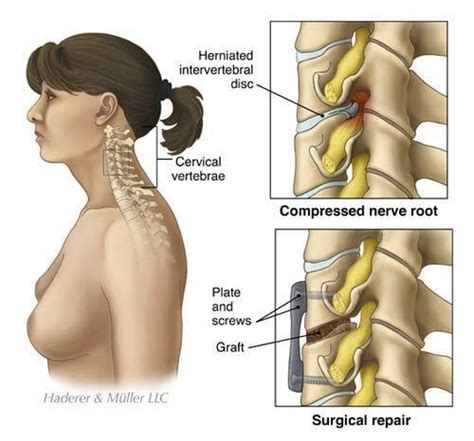 Herniated Disc Cervical/ACDF - Slipped Disc in the Neck - Little Rock ...