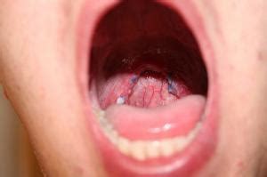 Mucus in throat causes and treatment | General center | SteadyHealth.com