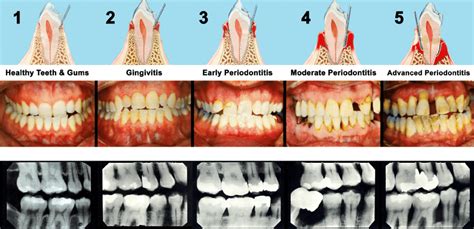 Periodontal Disease Stages