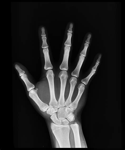 Broken Index Finger X Ray