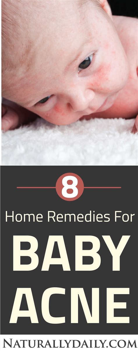 8 Safe Home Remedies for Baby Acne - Naturally Daily