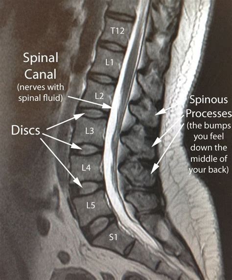 lumbar normal sag mri w text | Mri, Mri technologist, Mri scan