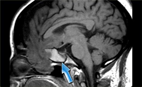 The Radiology Assistant : Paranasal Sinuses - MRI