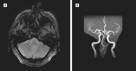 Vertebral Artery Susceptibility Sign as a Marker of Vertebral ...