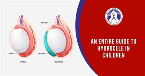 AN ENTIRE GUIDE TO HYDROCELE IN CHILDREN!