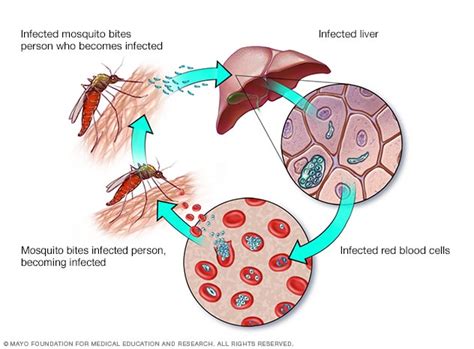 Malaria - Symptoms and causes - Mayo Clinic