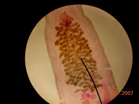 Clonorchis sinensis