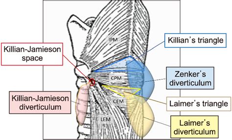 Anatomical illustration of pharyngoesophageal diverticulum (Zenker's ...