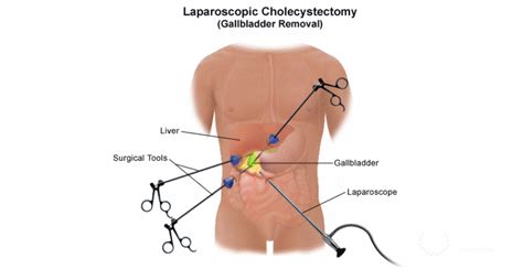 Laparoscopy cholecystectomy - indications, diagnosis, benefits