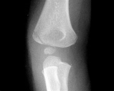 Lateral Condyle Fracture - Pediatric - Pediatrics - Orthobullets