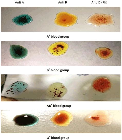 Frequency of expression and the distribution of ABO and Rh, Blood group ...