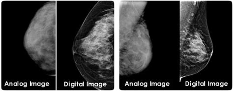 Digital Mammography | Lincoln Radiology