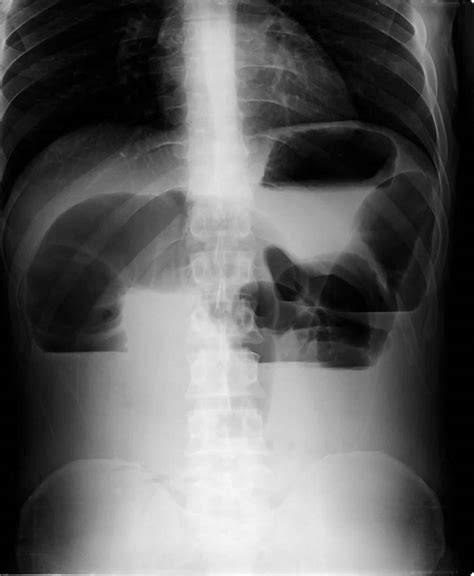 Intestinal ileus or paralytic ileus causes, symptoms, diagnosis & treatment