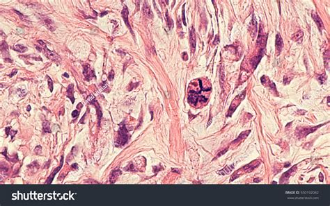 Photomicrograph Microscopic Image Breast Mastectomy Specimen Stock ...