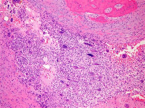 Giant Cell Tumor Histology