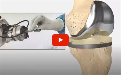 Robotic Knee Replacement: Everything you need to know - Northeast ...