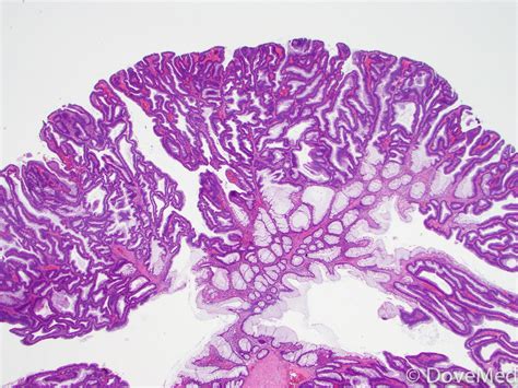 Adenoma Tubular Com Displasia De Alto Grau - BRAINCP