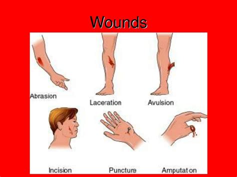 Avulsion Wound Definition