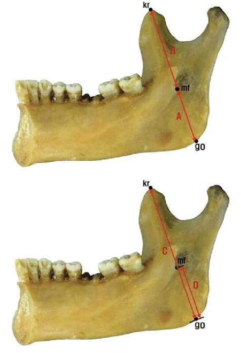 Measurements of the location of the mandibular foramen | Download ...