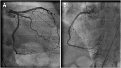 Coronary Angiogram Angioplasty