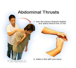 What is the Heimlich maneuver? - First Aid for Free