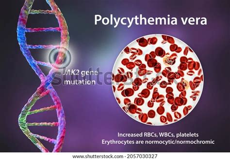 Polycythemia Vera–Meaning, Causes, Symptoms, Treatment