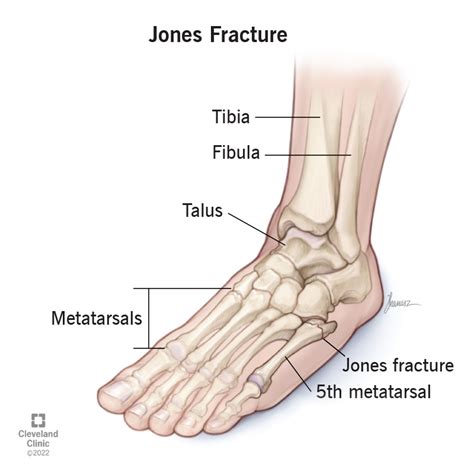 Jones Fracture: Symptoms, Causes & Treatment