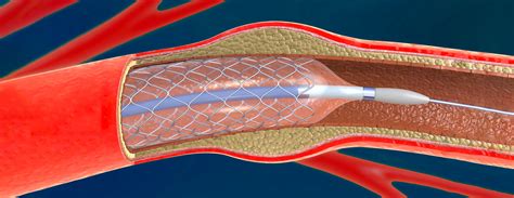 Transcarotid Artery Revascularization (TCAR) | Conditions & Treatments ...