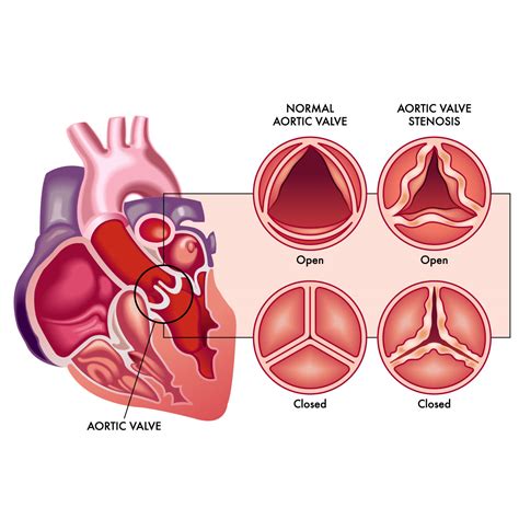 Aortic Valve Disease Causes And 2024 Insights | Vejthani