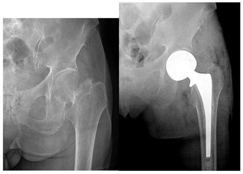 Geriatrics | Free Full-Text | Surgical Treatment of Femoral Neck ...