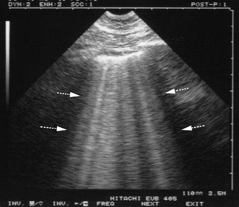 Acute Pulmonary Edema – Core EM