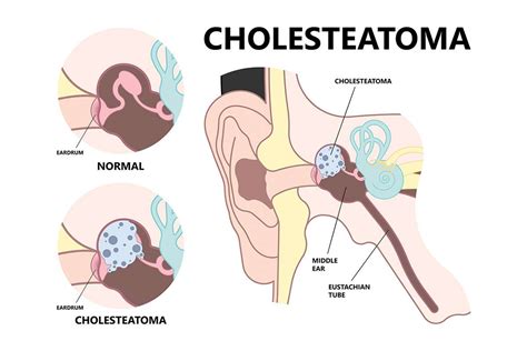 Cholesteatoma Doctor Philadelphia