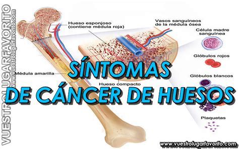 Sintomas Cancer De Huesos - SEO POSITIVO