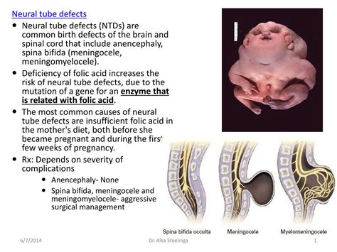 Neural Tube Defects Types