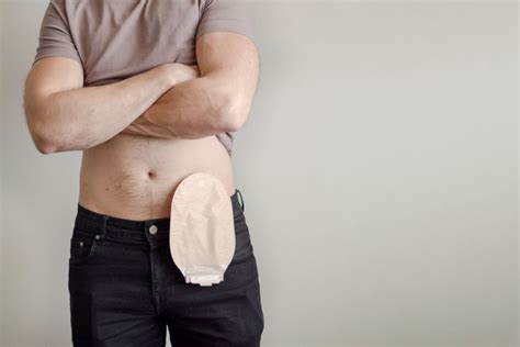 What is the Difference Between an Ostomy and a Colostomy?