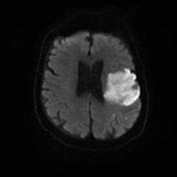 Restricted Diffusion - Differential Diagnosis | Diagnosis, Brain images ...