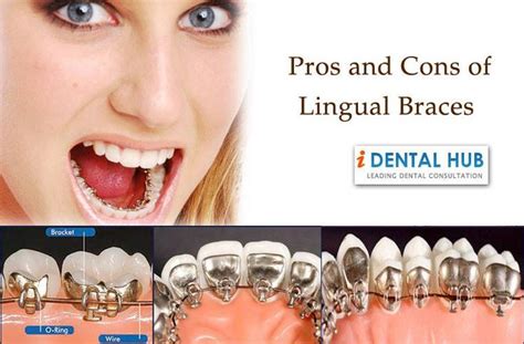 Pros and Cons of Lingual Brace | Lingual braces, Teeth braces, Teeth ...