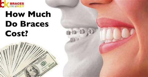 How Much Does It Cost To Remove Braces?- Braces Key