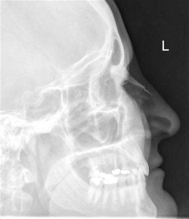 Nasal bone fracture | Image | Radiopaedia.org